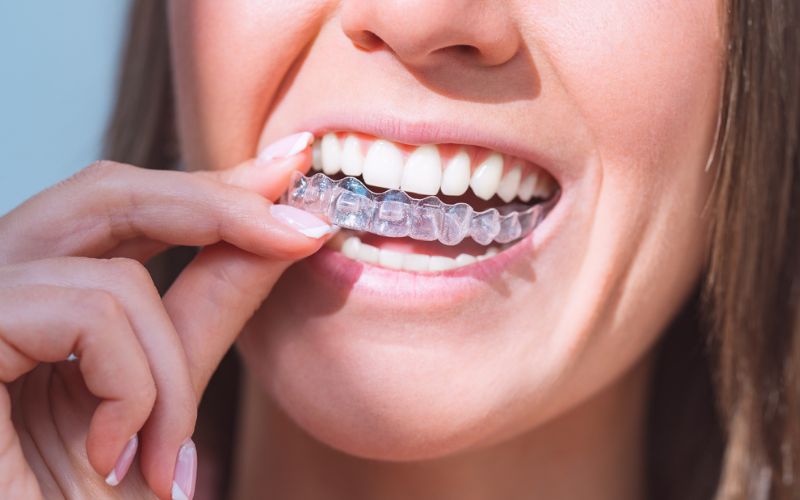 Top Reasons to Get Invisalign Clear Aligners in Mississauga: Addressing Dental Flaws for a Straighter Smile