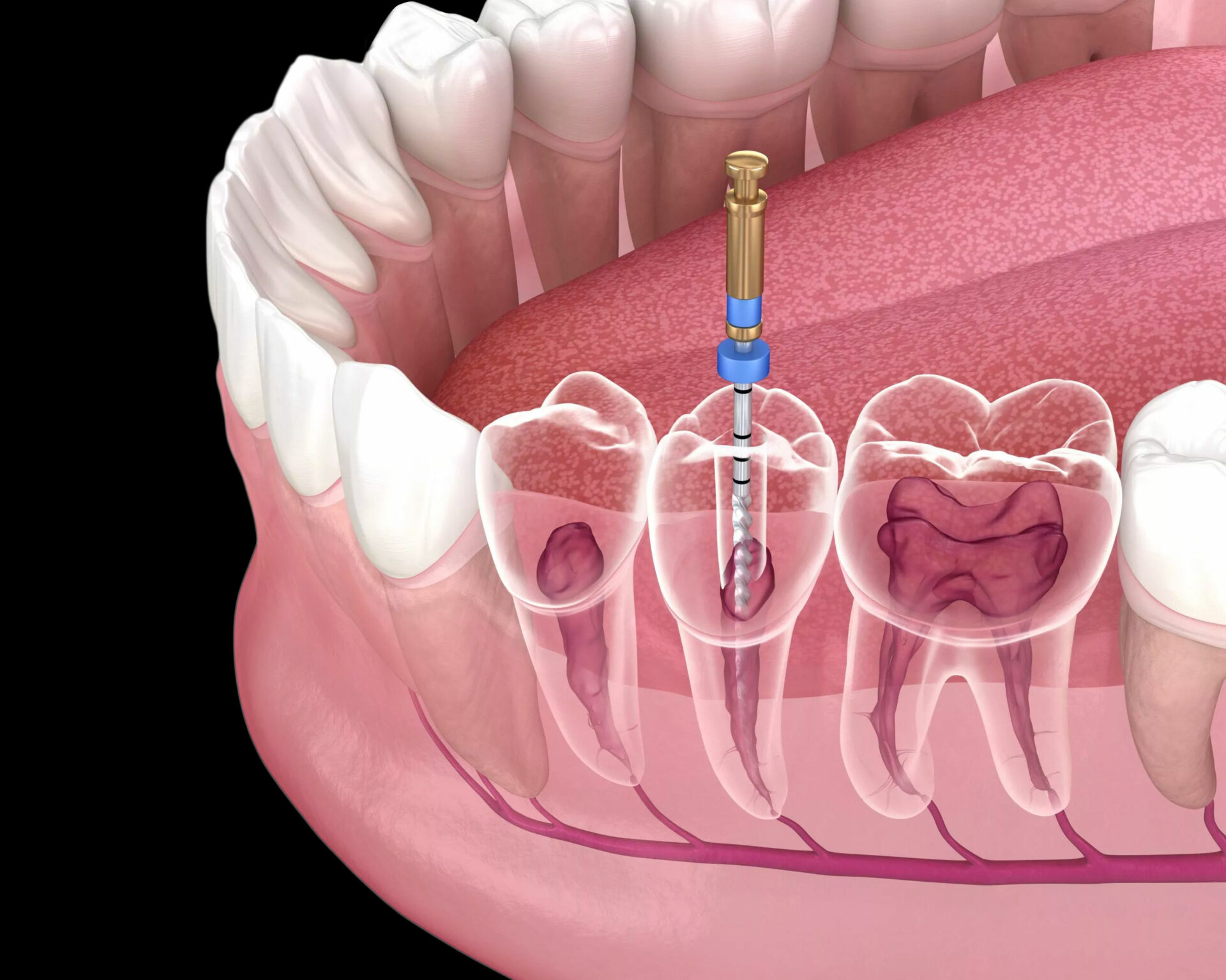 Silent Signals – Recognizing Root Canal Infections 